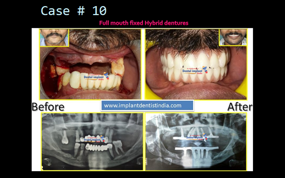 Full mouth fixed hybrid dentures treatment before and after at Dr. Sudhakar Reddy's Dental Implant Studio