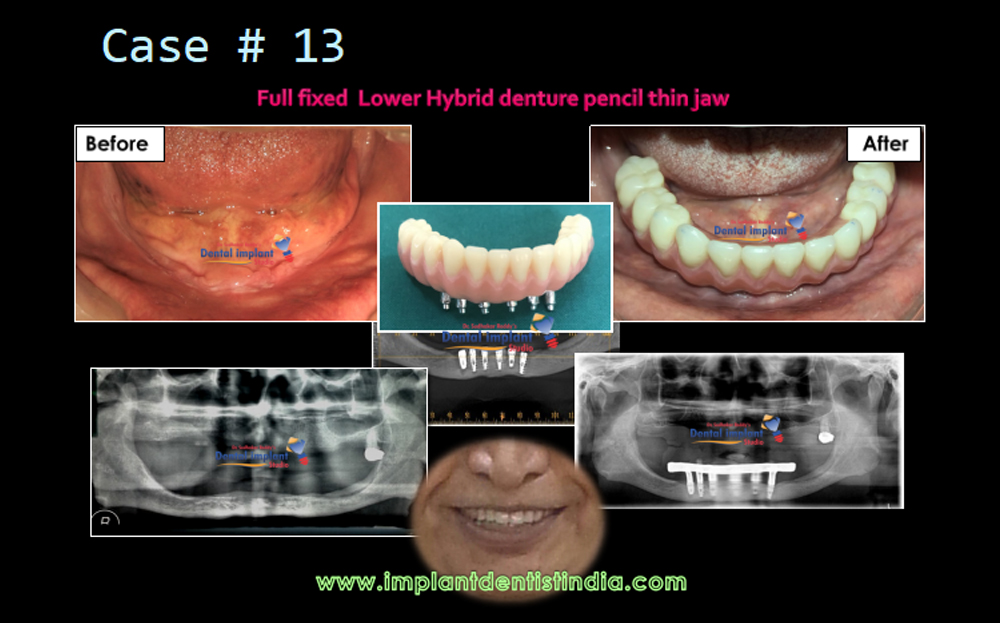 Full fixed lower hybrid denture pencil thin jaw case before and after treatment at Dr. Sudhakar Reddy