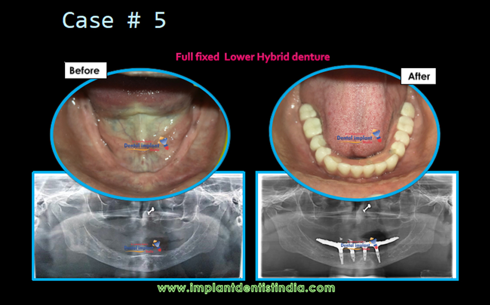 Full fixed lower hybrid dentures treatment before and after at Dr. Sudhakar Reddy's Dental Implant Studio
