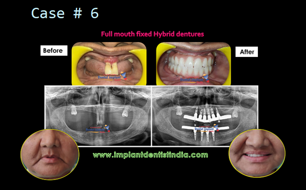 Full mouth fixed hybrid dentures treatment in Bangalore at Dr. Sudhakar Reddy