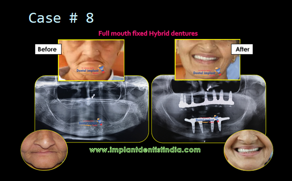 Full-mouth fixed hybrid denture treatment case before and after at Dr. Sudhakar Reddy