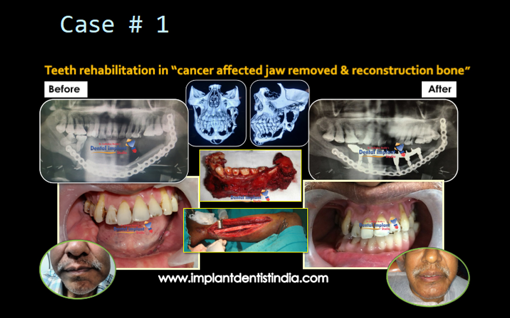 Teeth rehabilitation in cancer-affected jaw with bone reconstruction before and after at Dr. Sudhakar Reddy