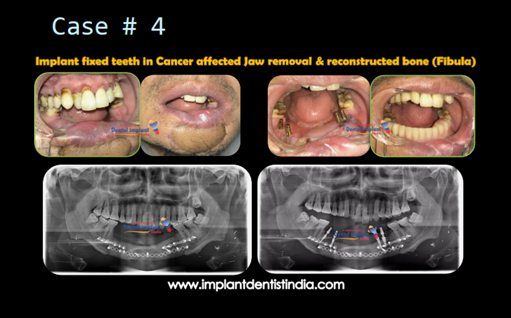 Implant fixed teeth in cancer-affected jaw removal and reconstructed bone (fibula) by Dr. Sudhakar Reddy, before and after