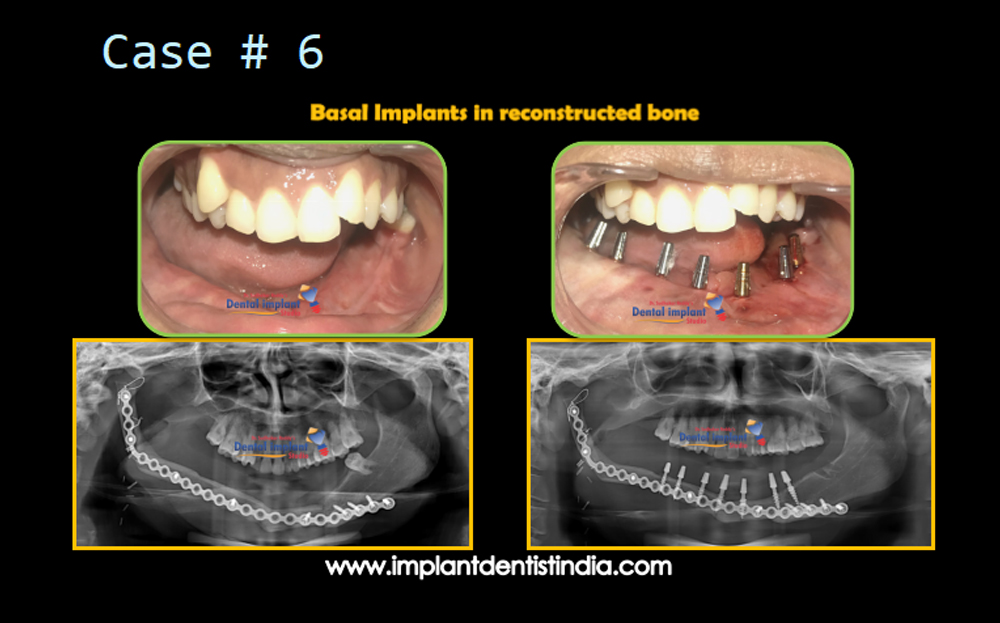 Basal implants in reconstructed bone by Dr. Sudhakar Reddy's Dental Implant Studio, before and after