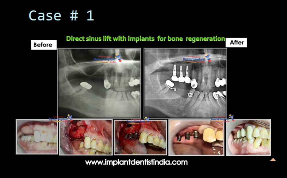 Direct sinus lift with implants for bone rehabilitation, before and after @ Dr. Sudhakar Reddy's Dental Implant Studio.