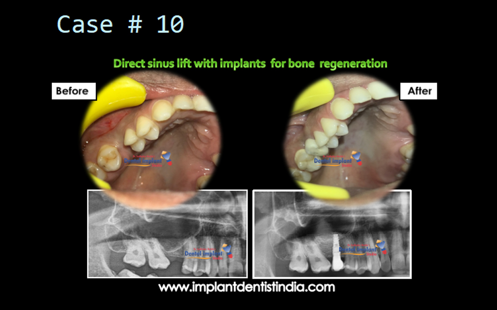 Direct sinus lift with dental implants for bone recovery treatment at Dr. Sudhakar Reddy's Dental Implant Studio in Bangalore.