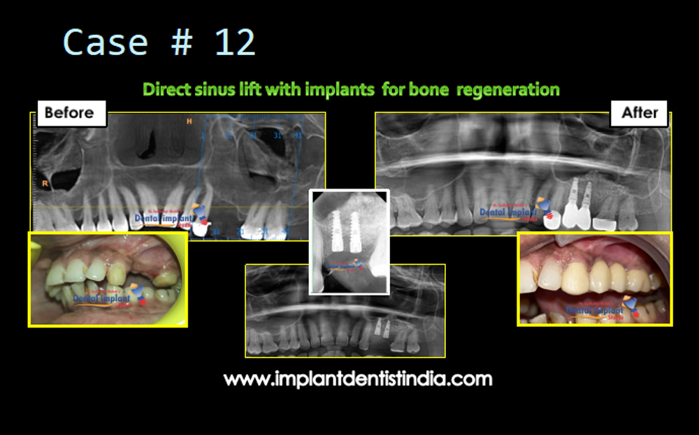 Direct sinus lift with dental implants for bone repair treatment at Dr. Sudhakar Reddy's Dental Implant Studio in Bangalore