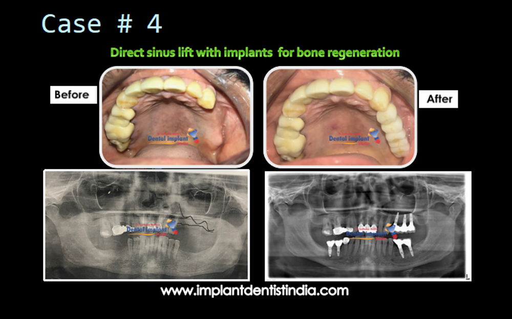 Direct sinus lift with implants for bone healing, before and after @ Dr. Sudhakar Reddy's Dental Implant Studio.
