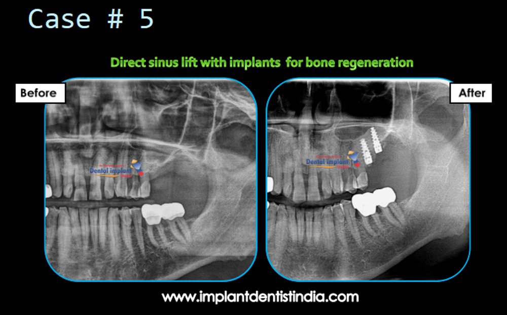 Direct sinus lift with implants for bone Rebuilding, before and after @ Dr. Sudhakar Reddy's Dental Implant Studio. 