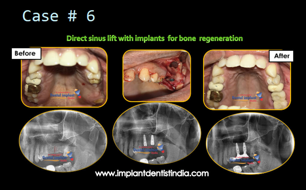 Direct sinus lift with implants for bone regeneration, before and after @ Dr. Sudhakar Reddy's Dental Implant Studio.