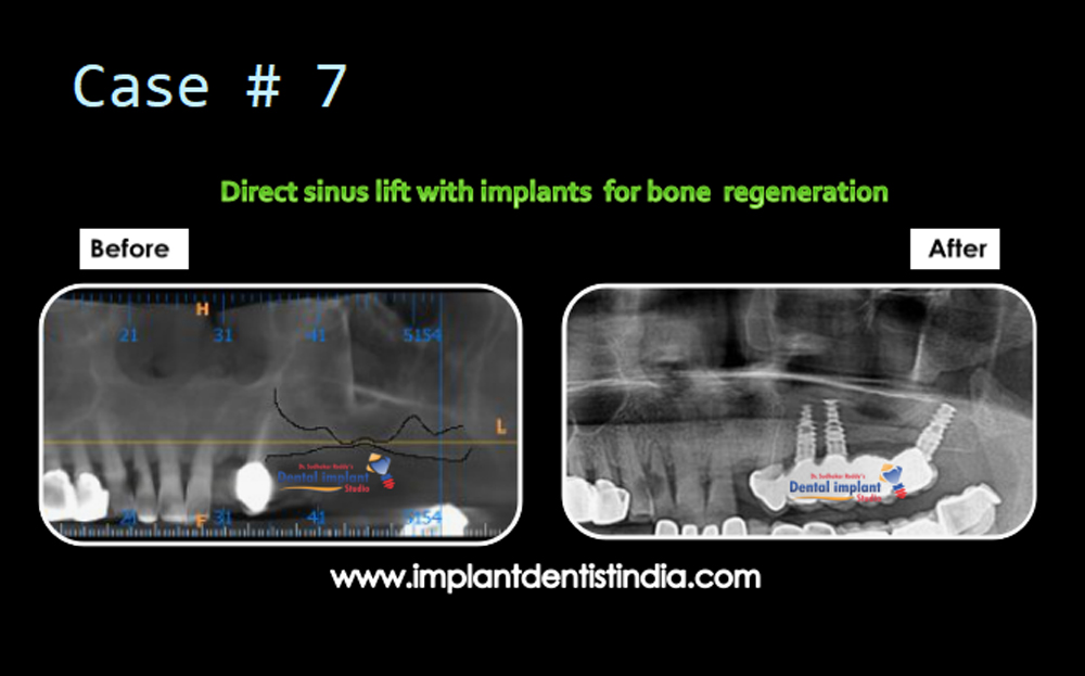 Direct sinus lift with implants for bone restoration before and after @ Dr. Sudhakar Reddy's Dental Implant Studio.