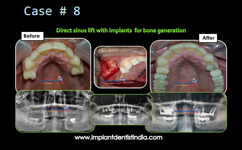 Direct sinus lift with implants for bone generation, before and after @ Dr. Sudhakar Reddy's Dental Implant Studio.