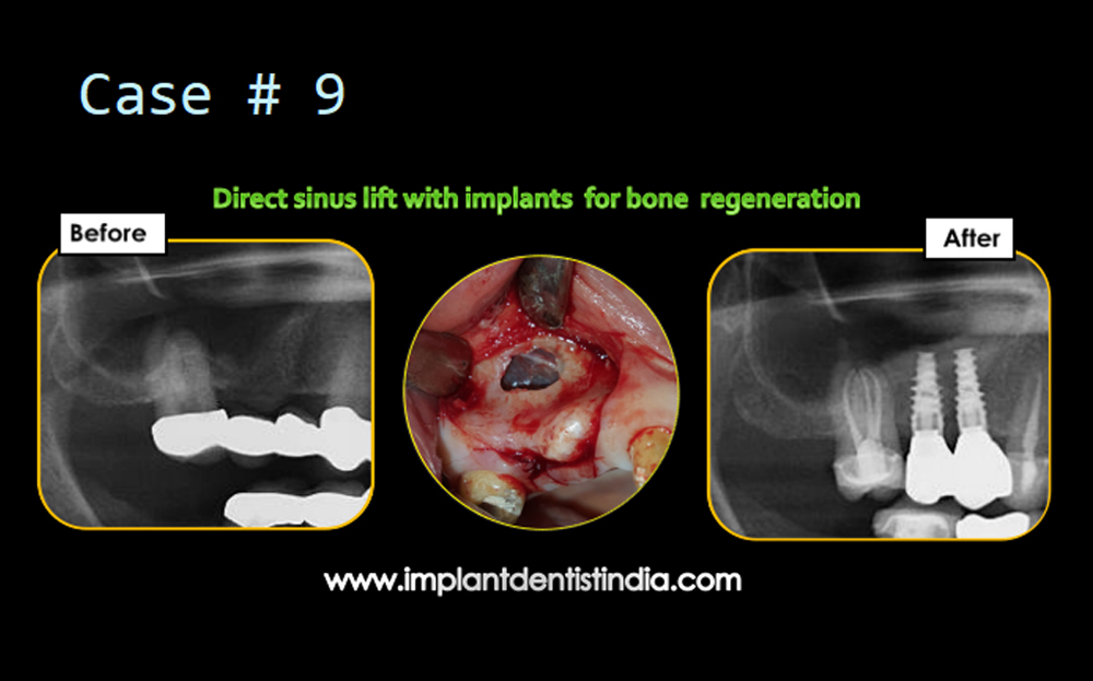 Direct sinus lift with dental implants for bone rehabilitation treatment in Bangalore at Dr. Sudhakar Reddy