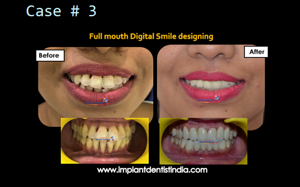 Full mouth digital smile designing treatment case before and after @ Dr. Sudhakar Reddy's Dental Implant Studio