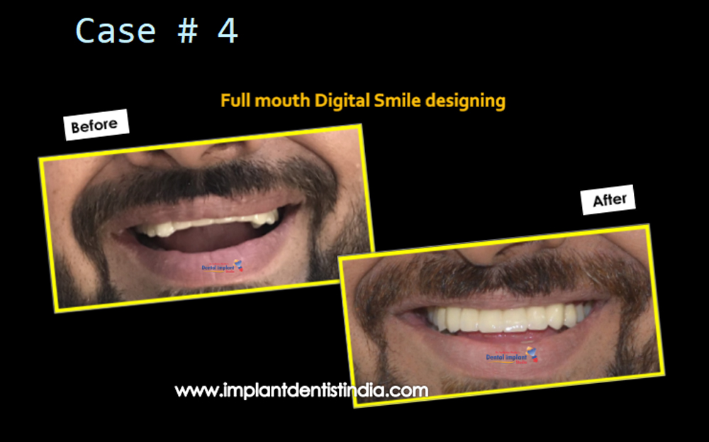 Full mouth digital smile designing treatment in Bangalore case before and after @ Dr. Sudhakar Reddy