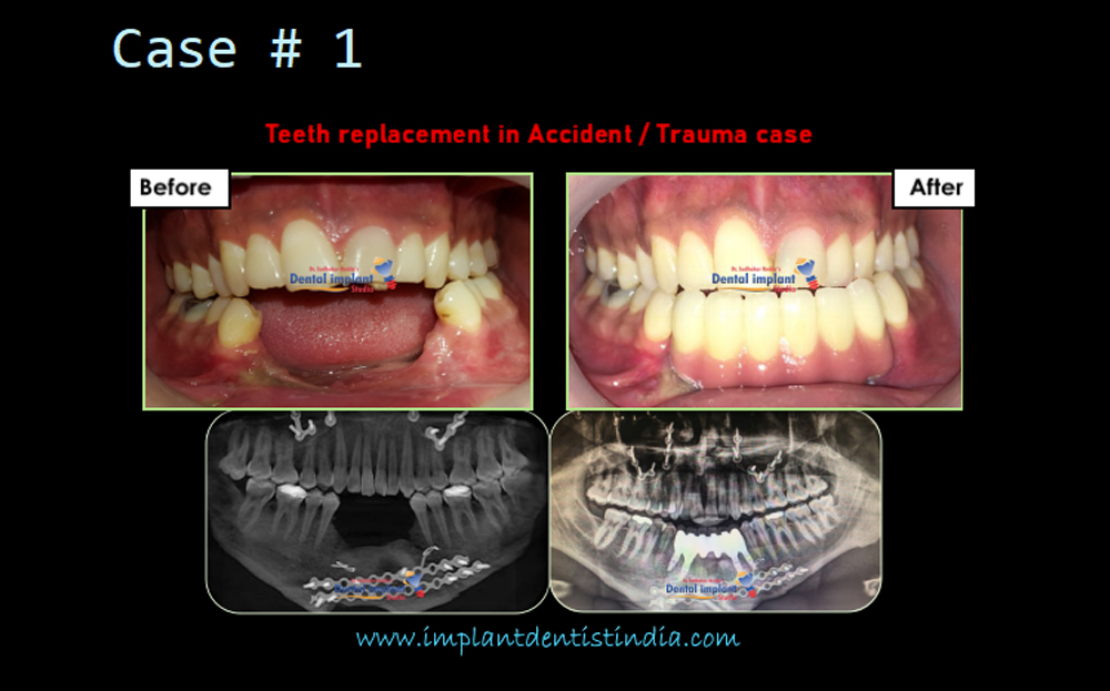 Teeth restoration in accident/trauma case before and after @ Dr. Sudhakar Reddy's Dental Implant Studio