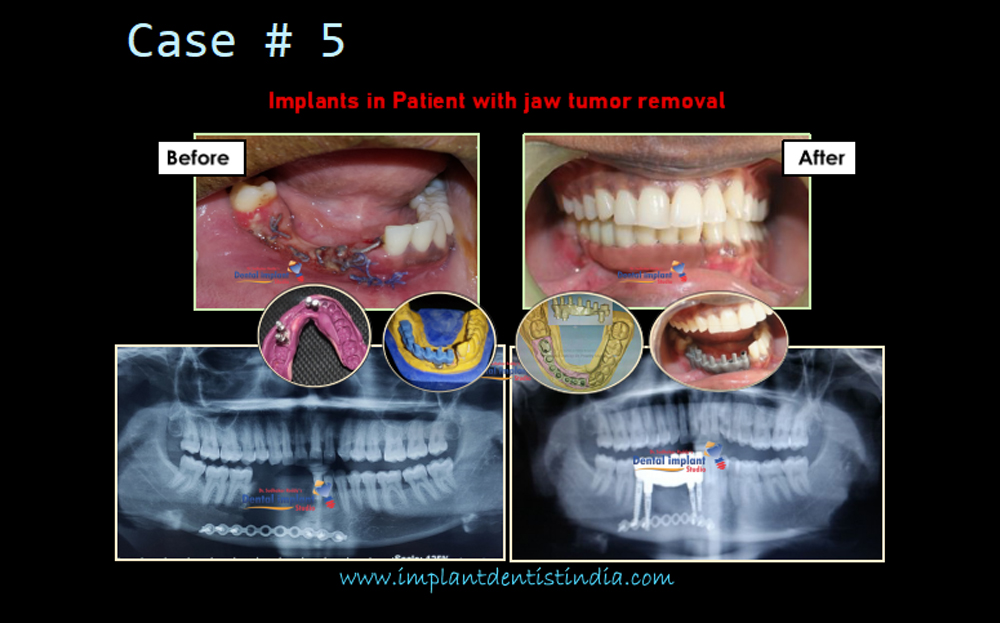 Dental implants in patients with jaw tumor removal case before and after @ Dr. Sudhakar Reddy's Dental Implant Studio