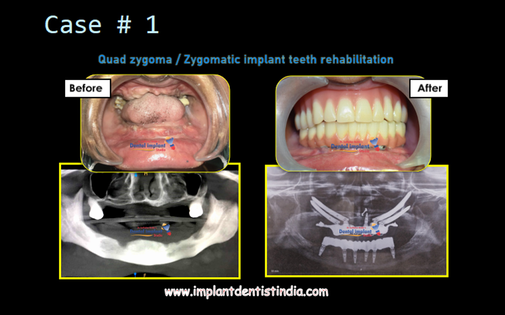 Quad zygoma/zygomatic implant teeth rehabilitation before and after at Dr. Sudhakar Reddy's Dental Implant Studio