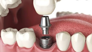 Best Dental Implant in Bangalore @ Dr. Sudhakar Reddy's Dental Implant Studio