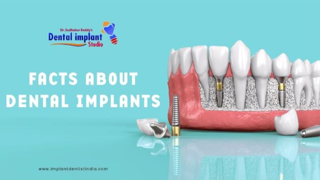 Facts about dental implants at Dr. Sudhakar Reddy