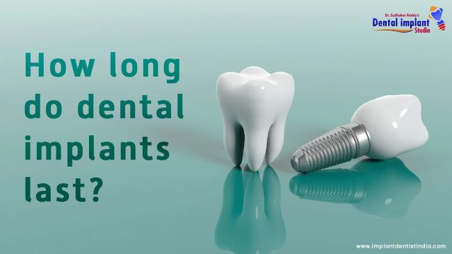 How Long Do Dental Implants Last? at Dr. Sudhakar Reddy's Dental Implant Studio