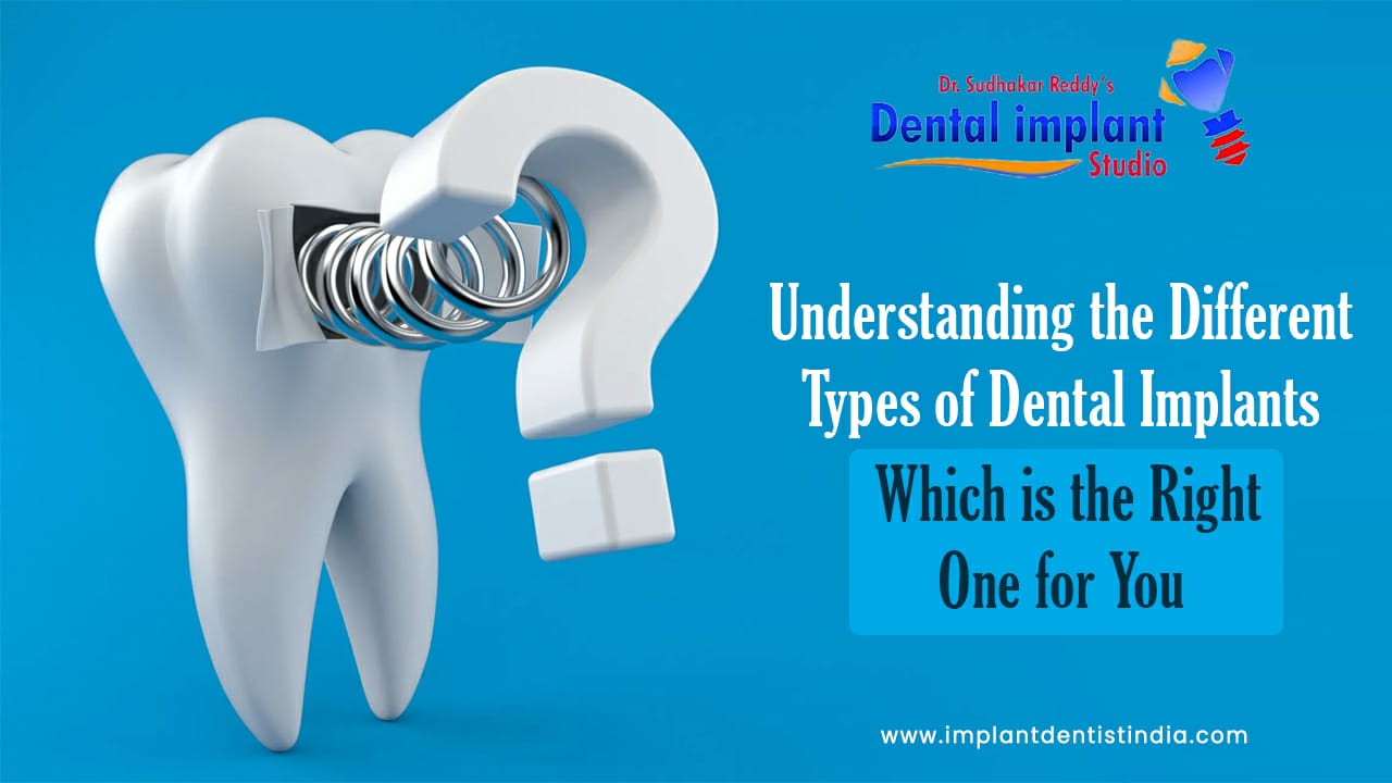 Understanding the Different Types of Dental Implants @Dental Implant Studio