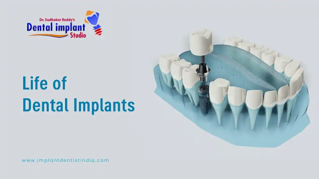 Life of Dental Implants at Dr. Sudhakar Reddy's Dental Implant Studio