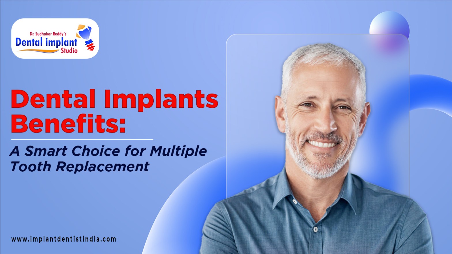 Dental Implants Benefits: A Smart Choice for Multiple Tooth Replacement